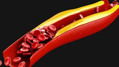 أبرزها البقوليات.. أطعمة تساعد على خفض مستويات الكوليسترول في الدم 