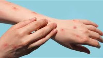 عدوى فيروسية تنتشر بين الصغار.. أستاذ أمراض جلدية يكشف أعراض متلازمة اليد والقدم والفم