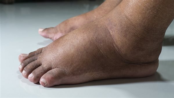 أسباب تورم الرجلين