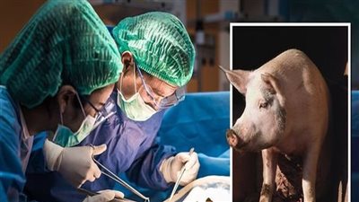 أول محاولة لزرع رئة خنزير داخل شخص ميت دماغيًا في الصين