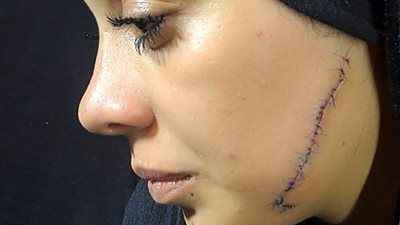 طليقة شاب تشوه وجه عروسه بـ 41 غرزة بمصر القديمة.. والضحية: نزلت على فيسبوك تتفاخر باللي عملته فيا