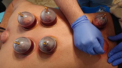 المستشفيات التركية تعلن بداية دخول الحجامة كعلاج تكميلي