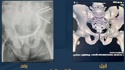 عظامه متفتتة.. نجاح عملية جراحية دقيقة لتثبيت كسور بالحوض لمريض بمجمع الأقصر الطبي الدولي
