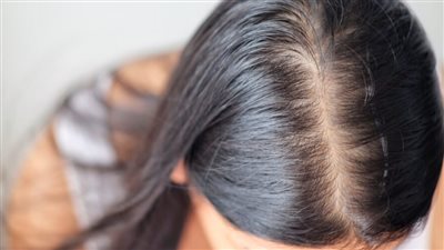 أفضل فيتامينات لتساقط الشعر.. 3 تحاليل يجب إجراؤها قبل العلاج