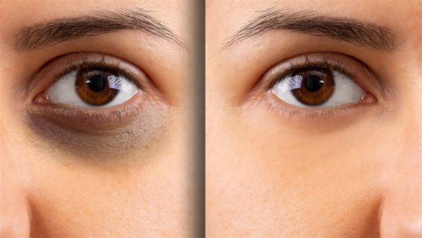 علاج الهالات السوداء