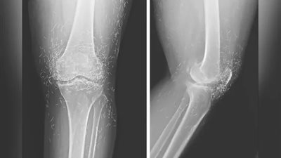 أطباء يعثرون على خيوط من الذهب الخالص في ركبتي امرأة