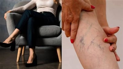 دراسة: وضع الساقين فوق بعضهما خلال الجلوس قد يسبب تجلط الأوردة العميقة