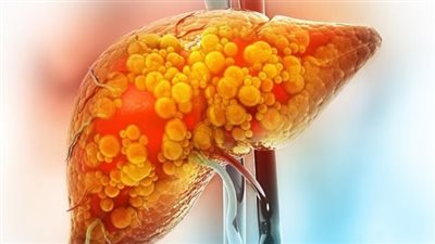 دراسة: حاملو فصيلة الدم A أكثر عرضة للإصابة بأمراض الكبد