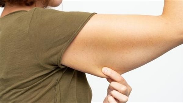 ترهل الجلد ـ تعبيرية