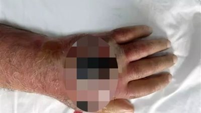 رجل مسن ينجو من بتر ذراعه بعد إصابته بعدوى خطيرة جراء عضة لص في تركيا