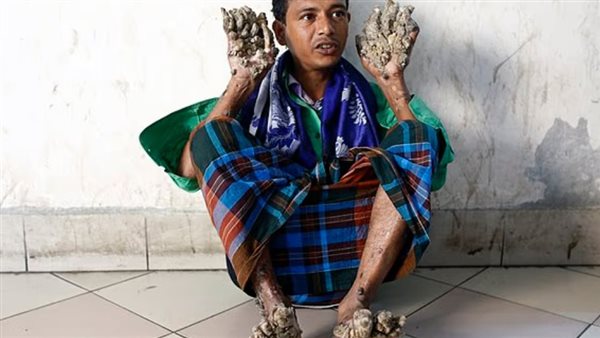 مريض في بنجلادش