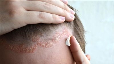 بعد تصدرها للتريند.. أستاذ أمراض جلدية يكشف علاقة الإكزيما بـ حلاقة الشعر عند الشباب