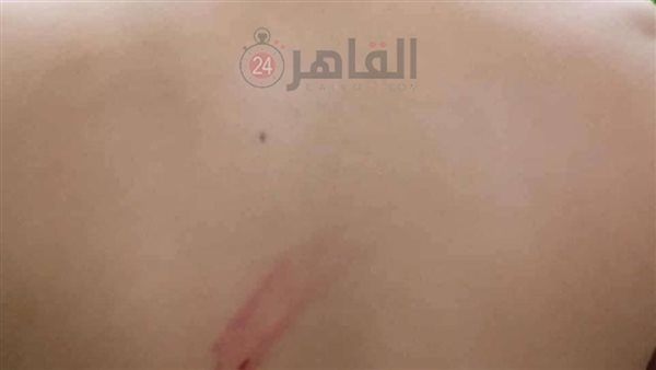 آثار الضرب على جسد