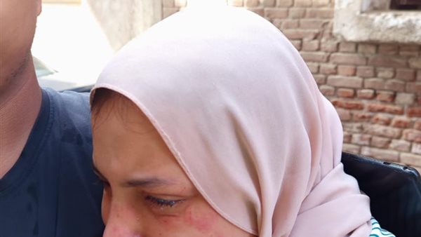 الفتاة المصابة 