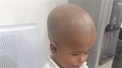 بعد استغاثة والدته عبر القاهرة 24.. استجابة عاجلة من الصحة لإنقاذ صغير مصاب باستسقاء في المخ