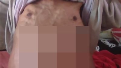 أنا عارف مصيري.. علاء مصاب بالورم والشلل النصفي ويناشد المسؤولين: نفسي أطمن على عيالي