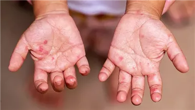 بعد رصد 4 حالات في إحدى المدارس.. ما هو فيروس HFMD وأعراضه؟