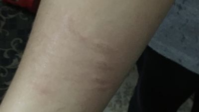 ضربته بـ العكاز وقفلت الفصل عليه.. معلمة تعتدي على طالب بمدرسة في شبرا