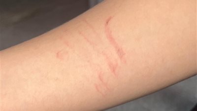 ضربته بالعكاز.. ولية أمر تطالب بالتحقيق في واقعة اعتداء على نجلها بمدرسة حافظ إبراهيم بشبرا