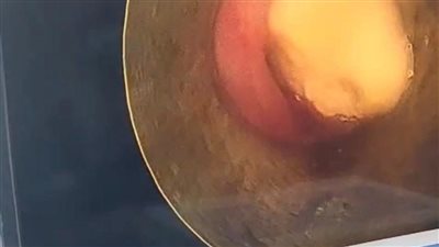 إنقاذ صغيرين من الاختناق بحبات لب وسوداني في مستشفى أطفال بنها التخصصي