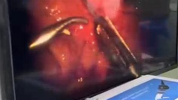 جانب من الجراحة