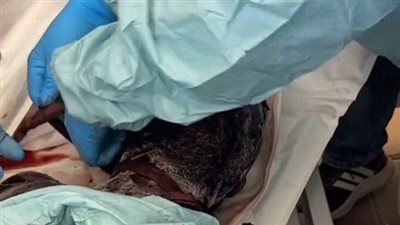 مدير مجمع الشفاء: جثامين الفلسطينيين التي تسلمناها من الاحتلال بحالة صعبة نتيجة التعذيب