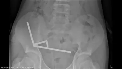 صبي يبتلع 100 مغناطيس اشتراها من 