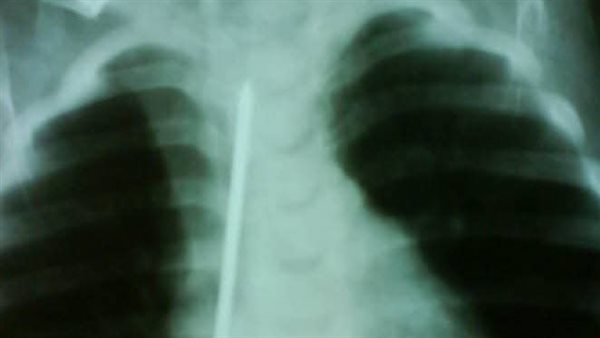 إنقاذ طفلة ابتلعت