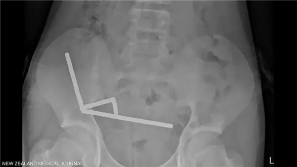 الصبي ابتلع نحو 100