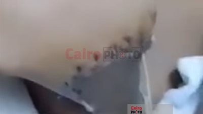 إصابة طفل ببتر في كف يده بسبب مفرمة لحوم داخل مطعم شهير ببورسعيد 