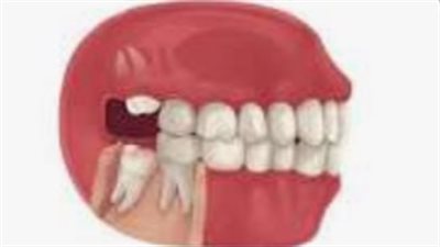 وفاة مفاجئة لفتاة أمريكية خلال خلع ضرس العقل.. والتحقيقات: اضطرابات جينية وعصبية