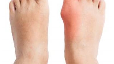 ماهي أعراض وطرق الوقاية من النقرس؟ 