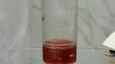 لأول مرة.. مستشفى العبور بكفر الشيخ يجري جلسة فصل البلازما لمريضة تعاني من مضاعفات كورونا (صور)