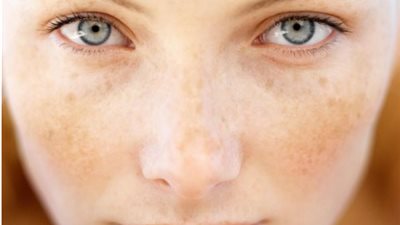 ما أسباب تصبغات البشرة؟