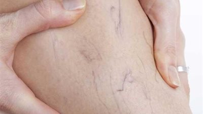 طبيب ذكورة يكشف السبب الرئيسي للإصابة بـ”دوالي الخصية” (فيديو)