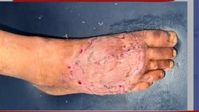 إنقاذ مريض كان يعاني من إصابة شديدة بالقدم اليمنى نتيجة مرور شاحنة عليها بمستشفى العامرية