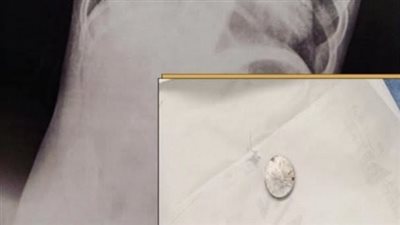 عمرة 10 أشهر.. فريق طبي بـ«مجمع الأقصر الطبي» ينقذ حياة رضيع ابتلع بطارية لعبة