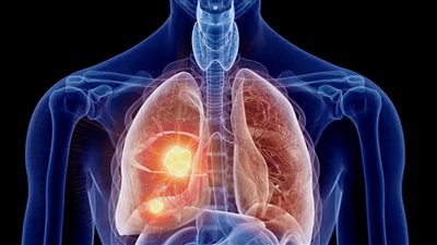 جهاز تنفّس مبتكر يكشف سرطان الرئة في مراحله الأولى
