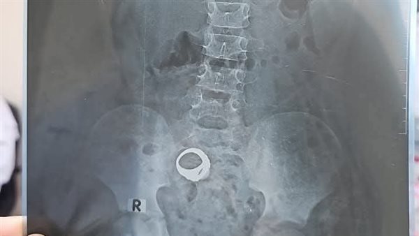 أشعة الطفل التي توضح