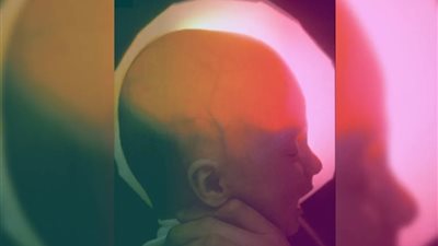 تحدت التوقعات الطبية.. شابة ولدت بنصف دماغ فقط تحتفل بعيد ميلادها العشرين 