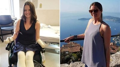 آلام في الفك تنتهي ببتر أطراف امرأة كندية