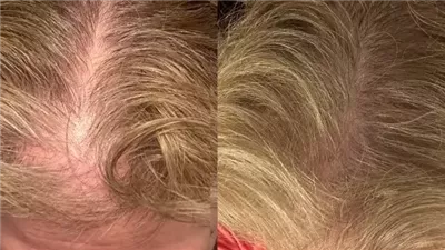 هل تساعد أجهزة الضوء الأحمر المنزلية في علاج تساقط الشعر؟.. خبراء يوضحون حقيقة الصيحة الجديدة