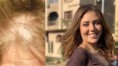 رحمة حسن في رسالة مؤثرة بعد تساقط شعرها بسبب خطأ طبي: ارتكبوا في حقي جريمة.. وعاهة مدى الحياة 