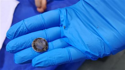 استخراج بطارية ابتلعها طفل عمره 5 سنوات بمستشفى أبو كبير المركزي بالشرقية