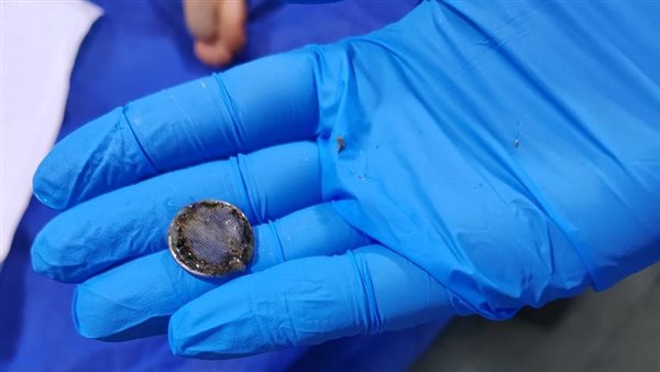 استخراج بطارية ابتلعها