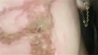 خبيرة تجميل تتسبب في إصابة سيدة أمريكية بحروق بالغة وندوب دائمة بسبب استخدام حمض حارق