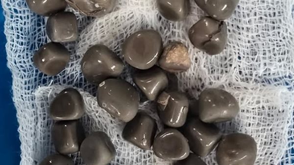 الحصوات المستخرجة