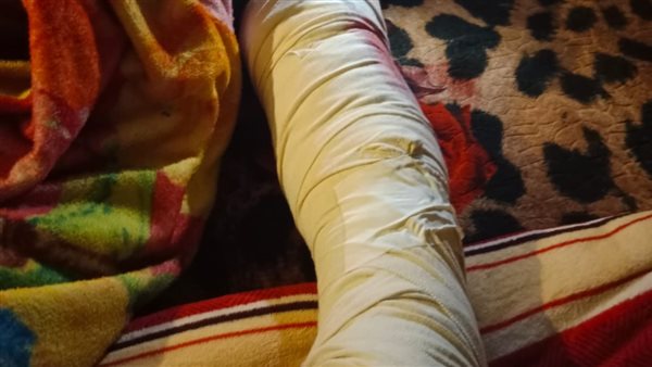 إصابة الطفل