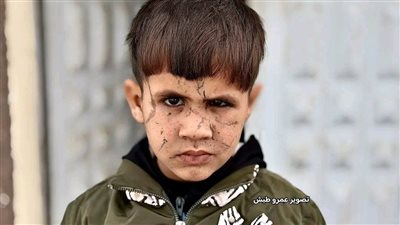 صحابي بيخافوا مني.. قصة طفل فلسطيني فقد عينه اليسرى وأصيب بتشوهات مؤلمة بسبب القصف الإسرائيلي