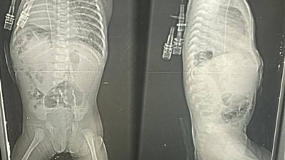 قادمة من العريش.. جراحة دقيقة تنقذ رضيعة عمرها 35 يومًا بمستشفى زاوية الناعورة في المنوفية